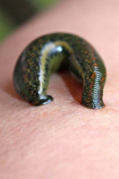 hirudotherapy, leech therapy